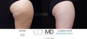 coolsculpting before after thighs
