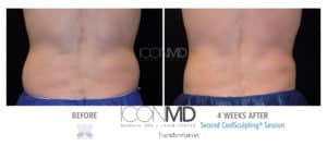 coolsculpting before after back