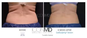 coolsculpting before after back