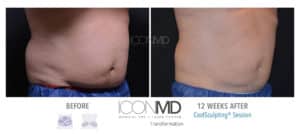 coolsculpting before after abdomen