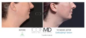 coolsculpting before after neck