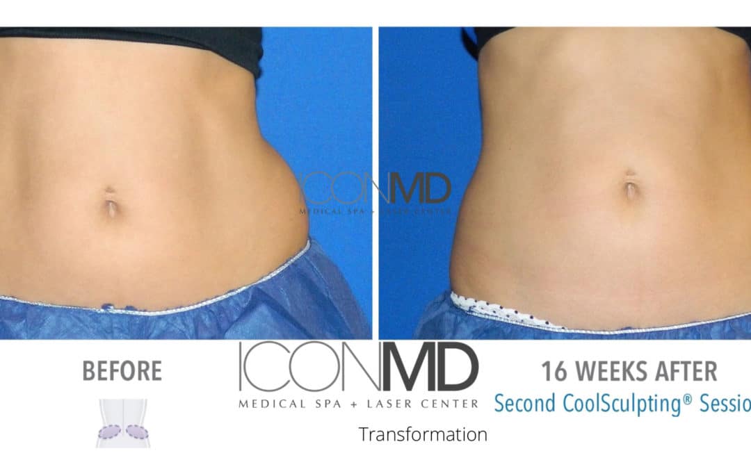 Tummy Tuck Archives - 50% Off CoolSculpting Boca Raton | Icon MD