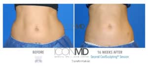 coolsculpting before after abdomen