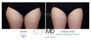 coolsculpting before after thighs