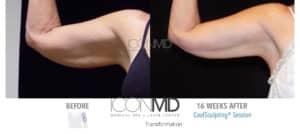 coolsculpting before after arms
