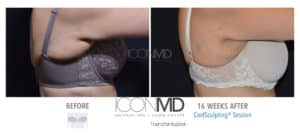 coolsculpting before after arms